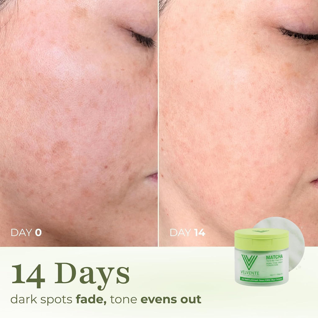 Matcha PDRN Korean Toner Pads, Dark Spots, Pores & Redness, Vegan | Gentle Exfoliation, Smoothing, Hydrating & Even Tone. AM&PM Acne-Prone Sensitive Skin 100Ct