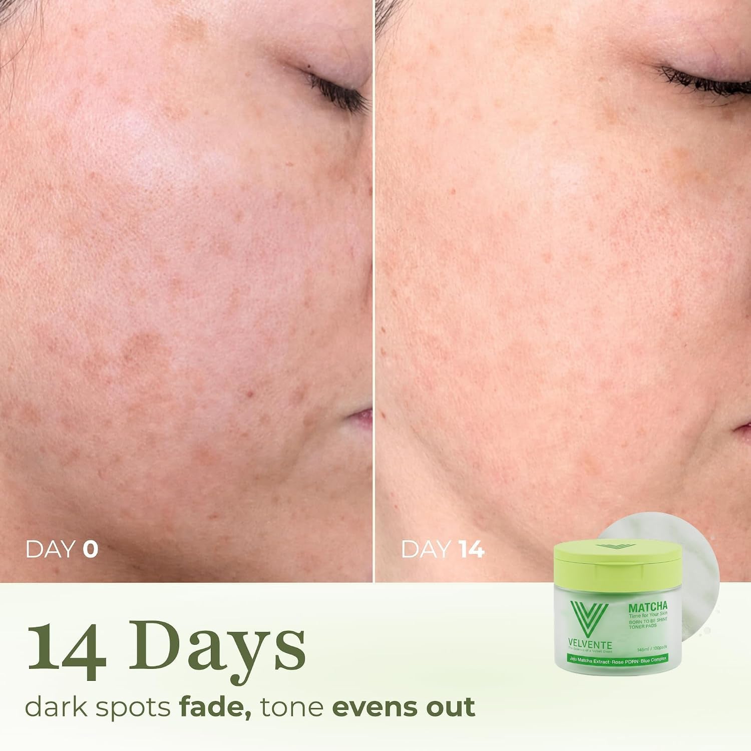 Matcha PDRN Korean Toner Pads, Dark Spots, Pores & Redness, Vegan | Gentle Exfoliation, Smoothing, Hydrating & Even Tone. AM&PM Acne-Prone Sensitive Skin 100Ct