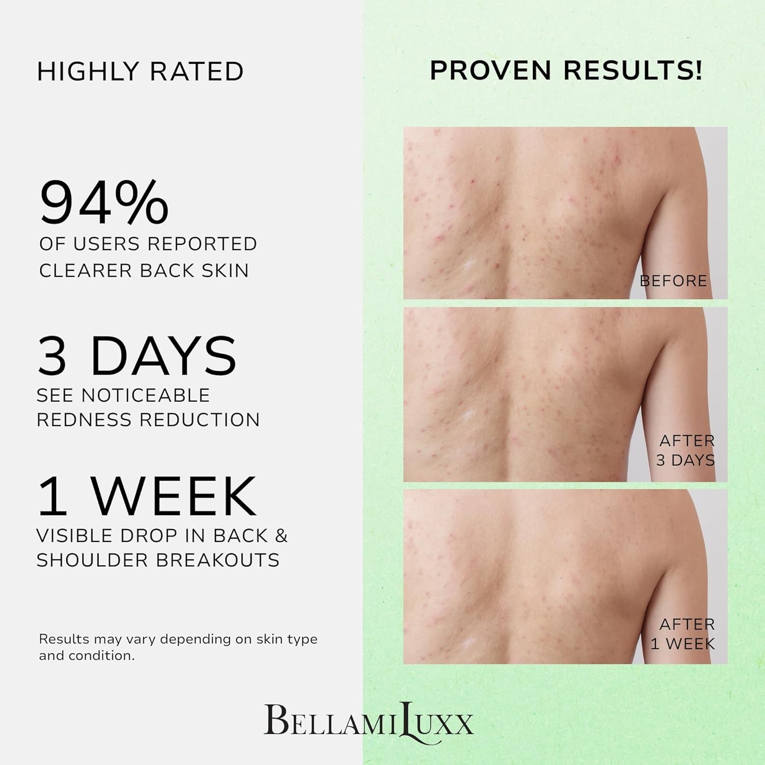 Back & Body Acne Treatment: 2% Salicylic Acid Back Acne Spray for Clear, Soothe & Moisturize - Effective Bacne Treatment with Tea Tree Oil, Body Acne Spray for Men, Women & Teens