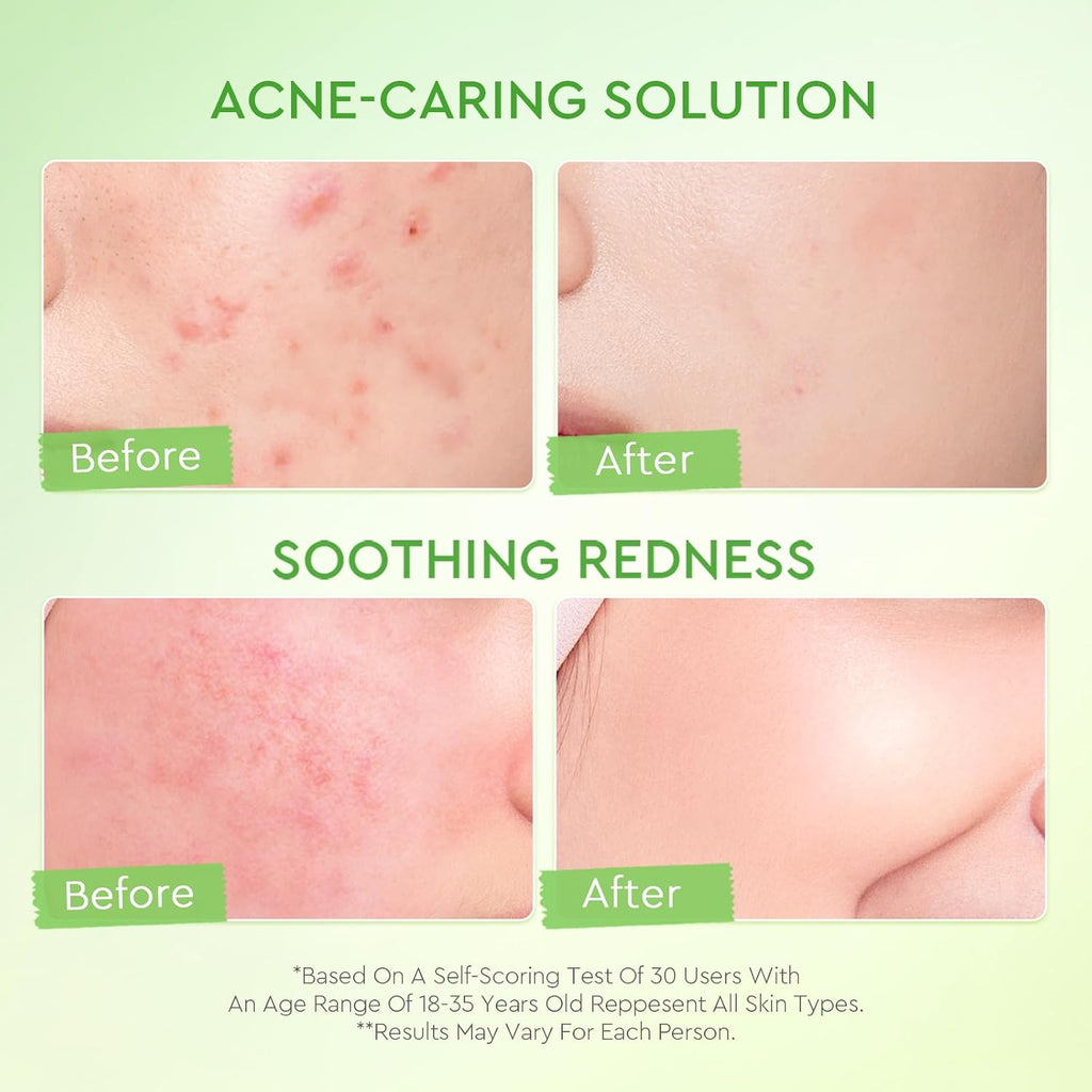 Oil Free Face Moisturizer for Oily Skin, for Blemish-Prone Skin with 3D Complex & Kiwi Extract, Lightweight Hydrating & Redness Calming, 100G