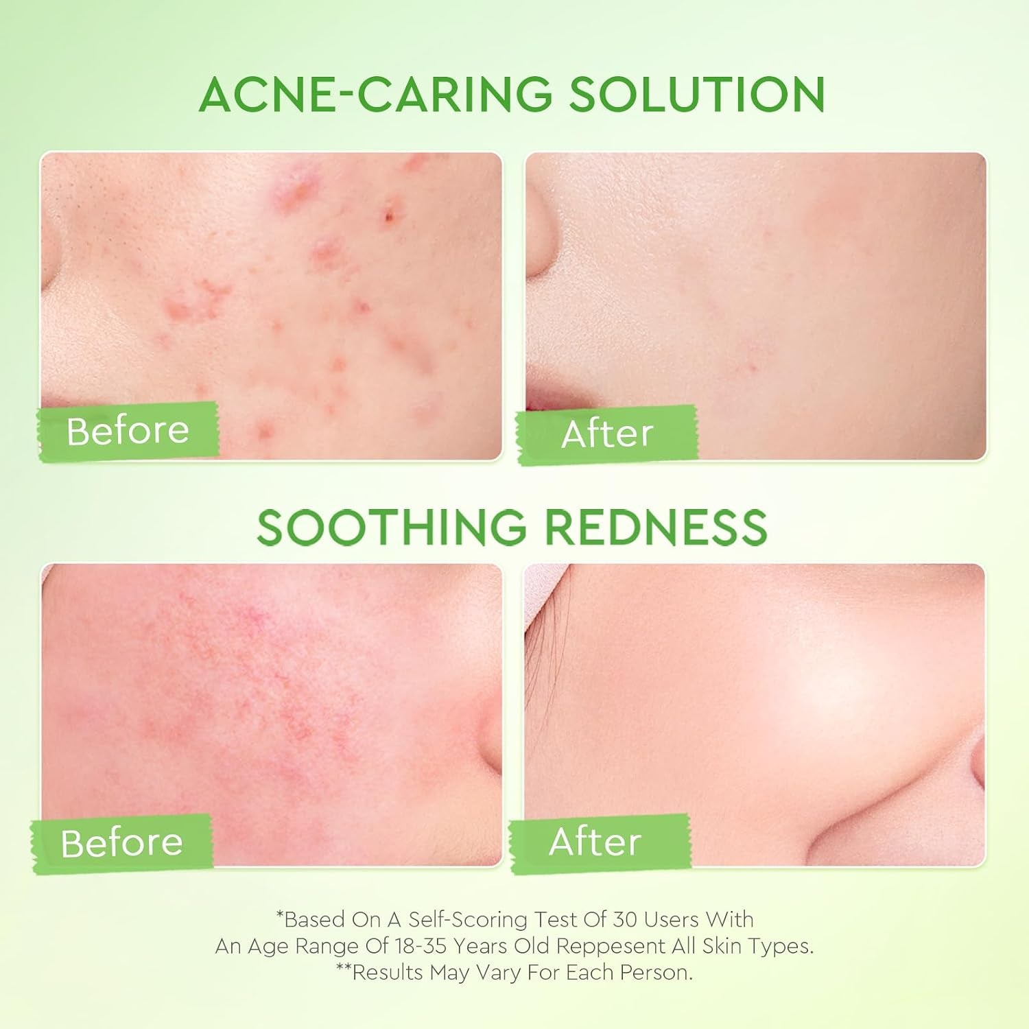 Oil Free Face Moisturizer for Oily Skin, for Blemish-Prone Skin with 3D Complex & Kiwi Extract, Lightweight Hydrating & Redness Calming, 100G