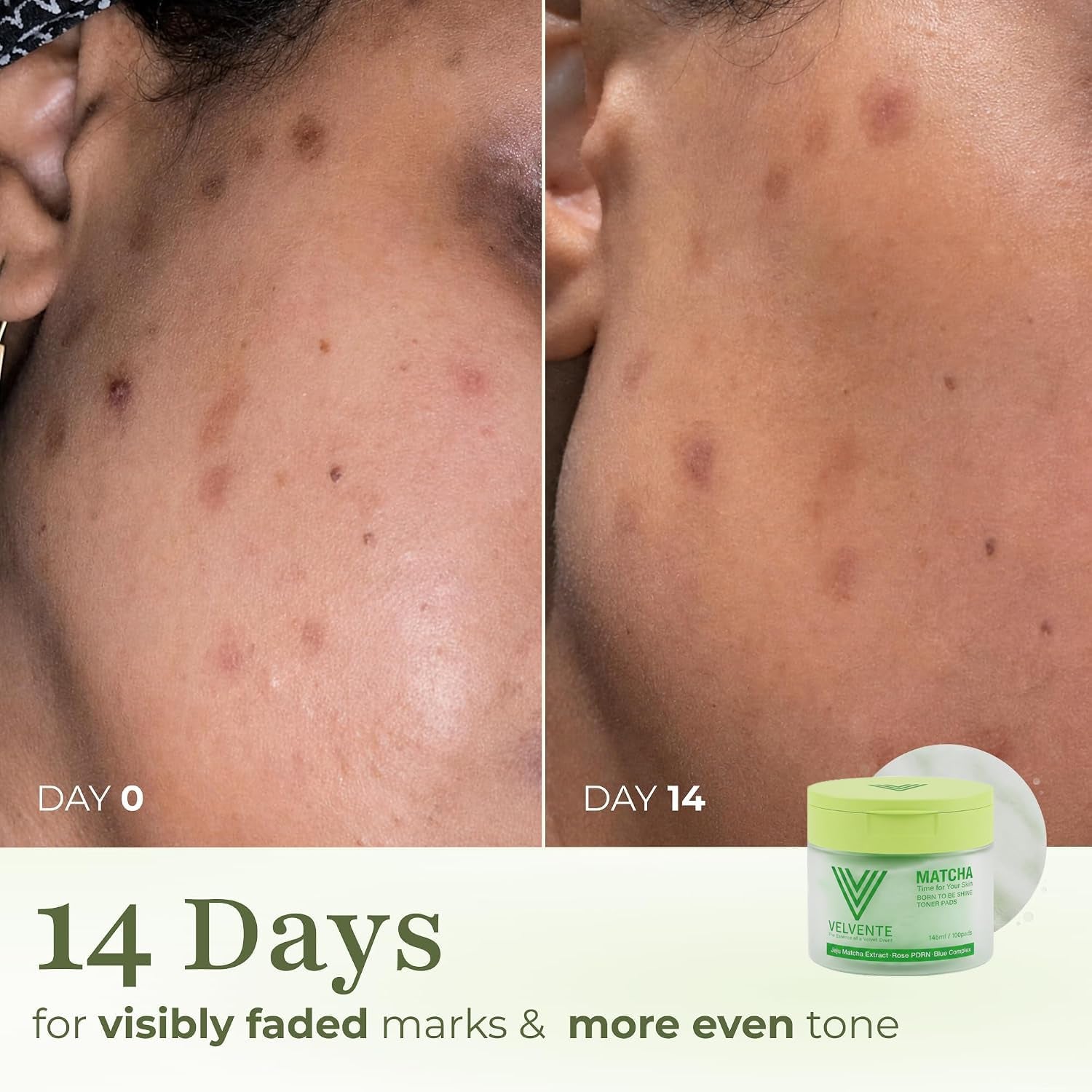 Matcha PDRN Korean Toner Pads, Dark Spots, Pores & Redness, Vegan | Gentle Exfoliation, Smoothing, Hydrating & Even Tone. AM&PM Acne-Prone Sensitive Skin 100Ct